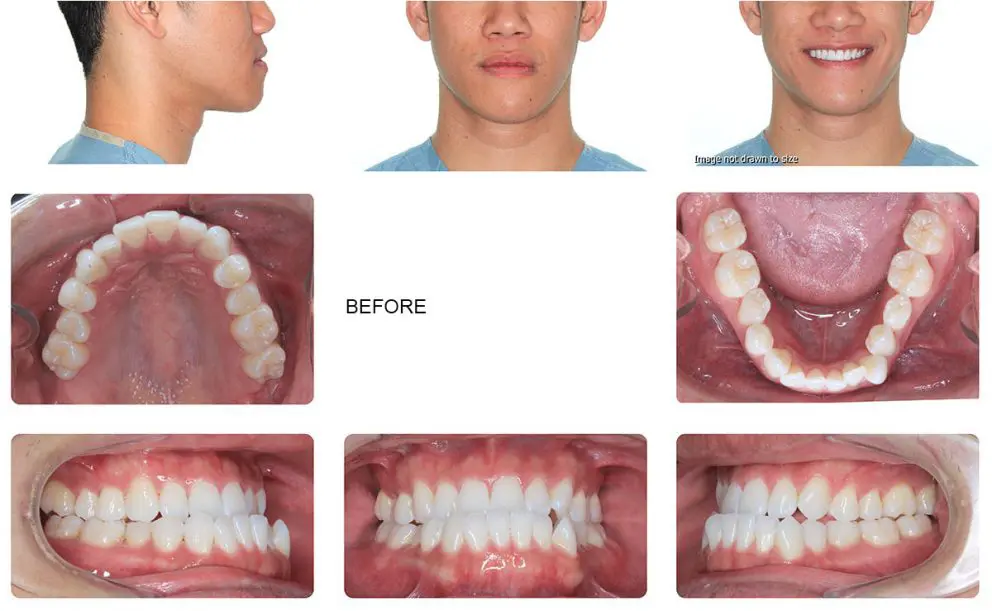 Surgical Orthodontics Before