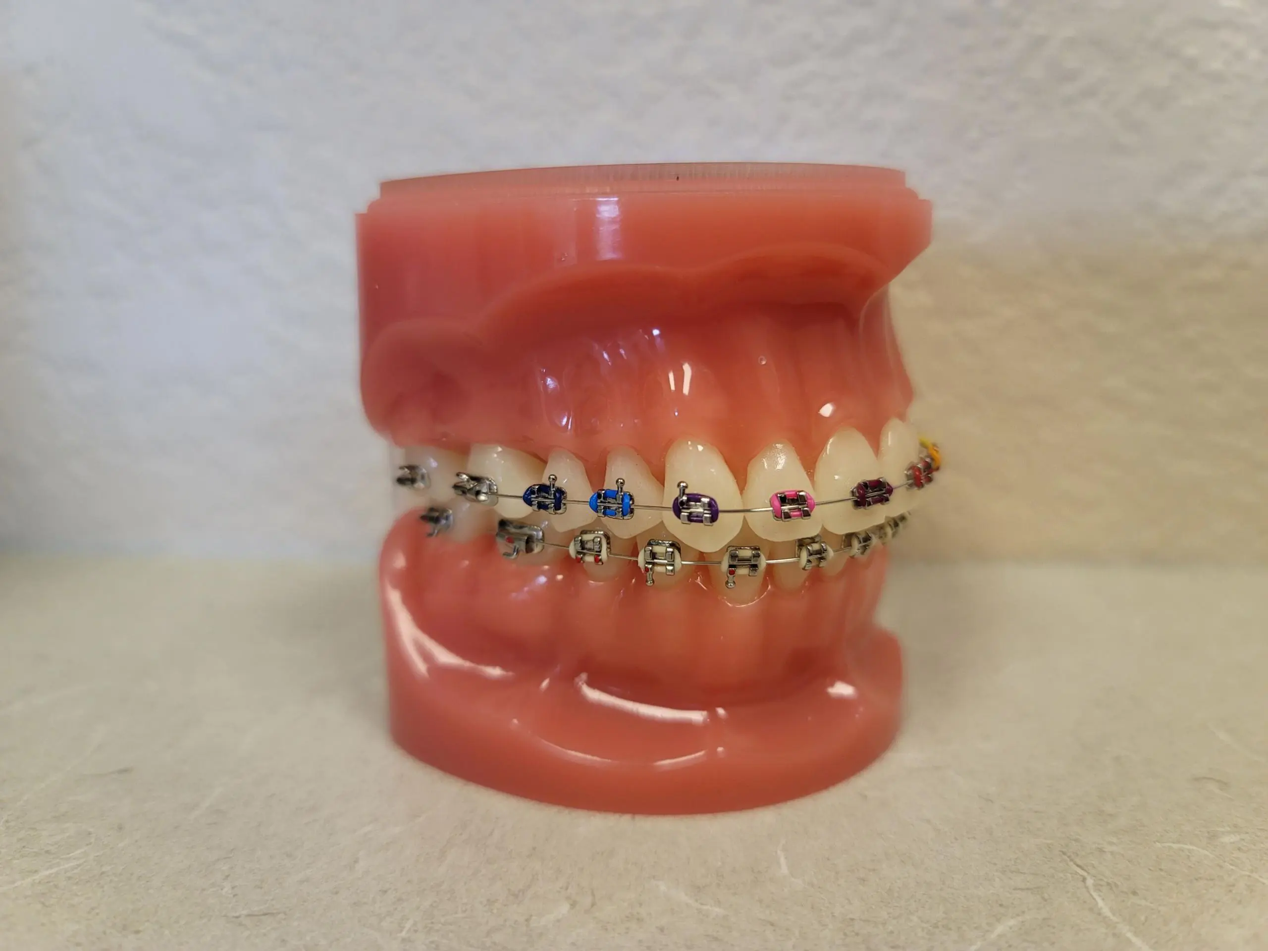 A dental model with metal braces, perfect for instructions at Natalie Yang Orthodontics Orthodontics in Vacaville, CA.