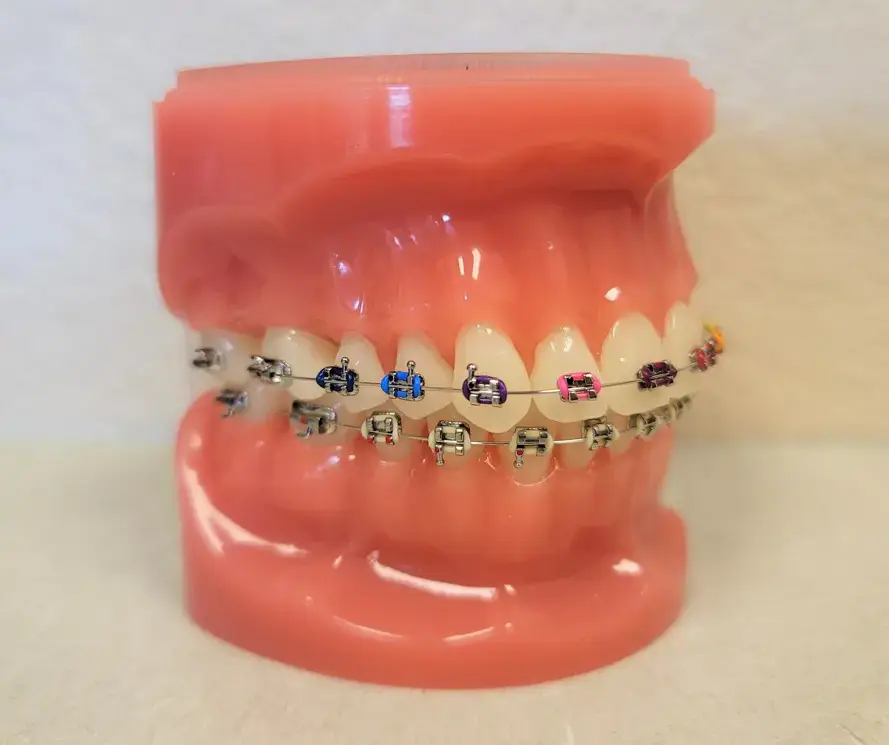 A dental model with colorful metal braces at Natalie Yang Orthodontics Orthodontics in Vacaville, CA, emphasizing dietary restrictions.