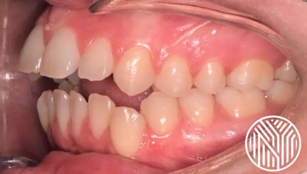 open bite problems