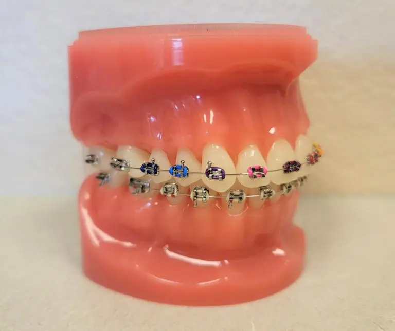 braces in Vacaville, CA