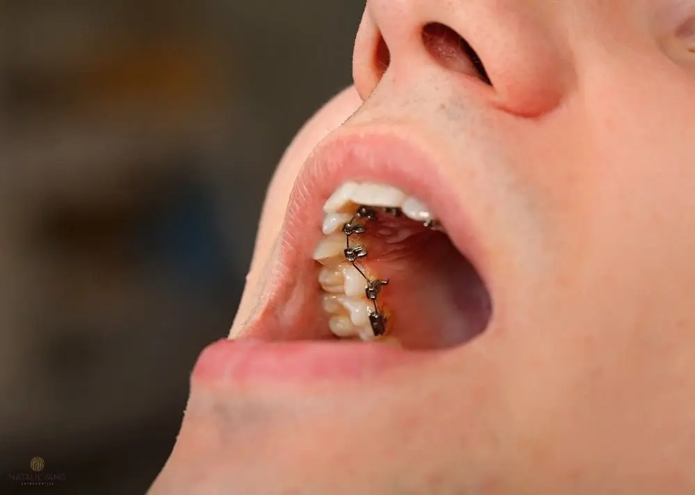 Close-up of a person’s open mouth showing metal braces on the upper and lower teeth as one of the Alternatives to Braces in Vacaville, CA..