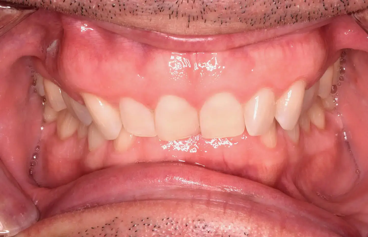 Open mouth with visible teeth, gums, lips, and facial hair—overbite treatment begin by Natalie Yang Orthodontics Orthodontics in Vacaville, CA. Open mouth with visible teeth, gums, lips, and facial hair—overbite treatment begin by Natalie Yang Orthodontics Orthodontics in Vacaville, CA.