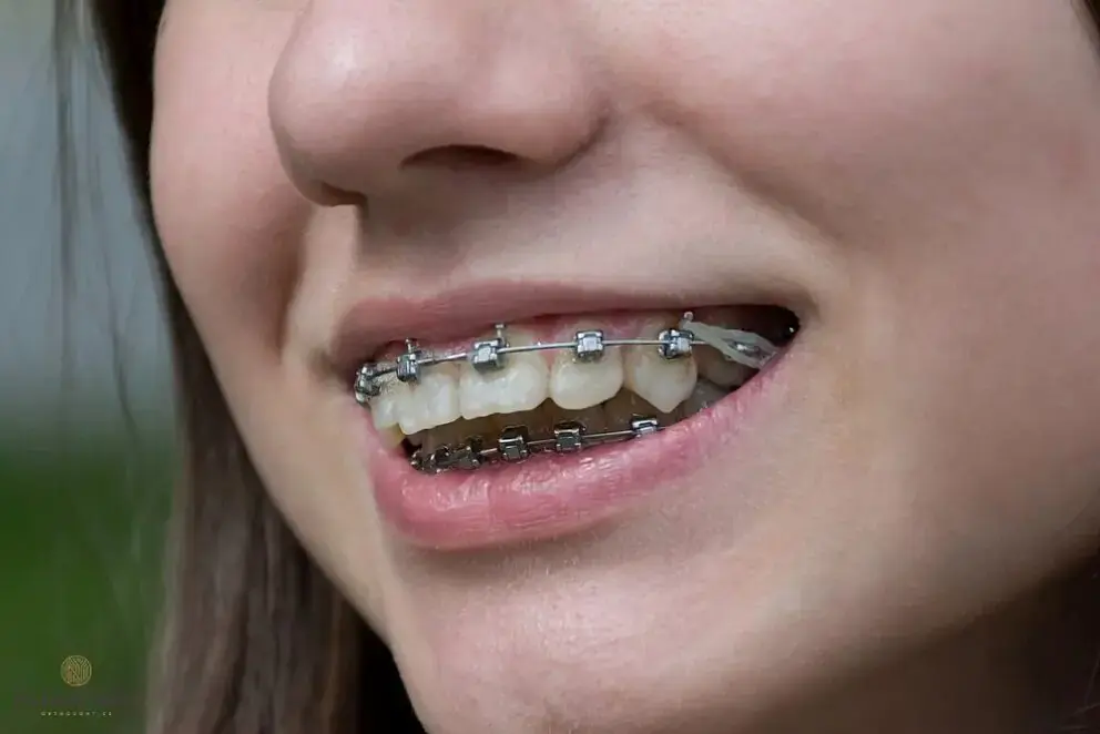 A close-up of metal braces with elastic bands correcting bite issues, at Natalie Yang Orthodontics Orthodontics in Vacaville, CA. A close-up of metal braces with elastic bands correcting bite issues, at Natalie Yang Orthodontics Orthodontics in Vacaville, CA.