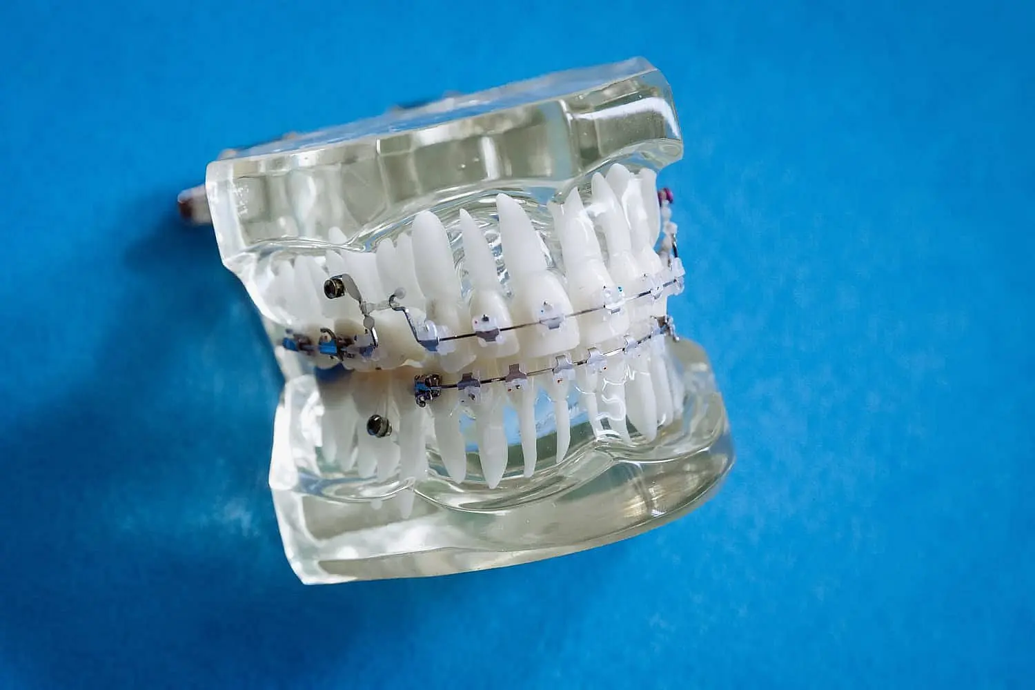 A plastic model of metal braces displayed at Natalie Yang Orthodontics in Vacaville, CA.