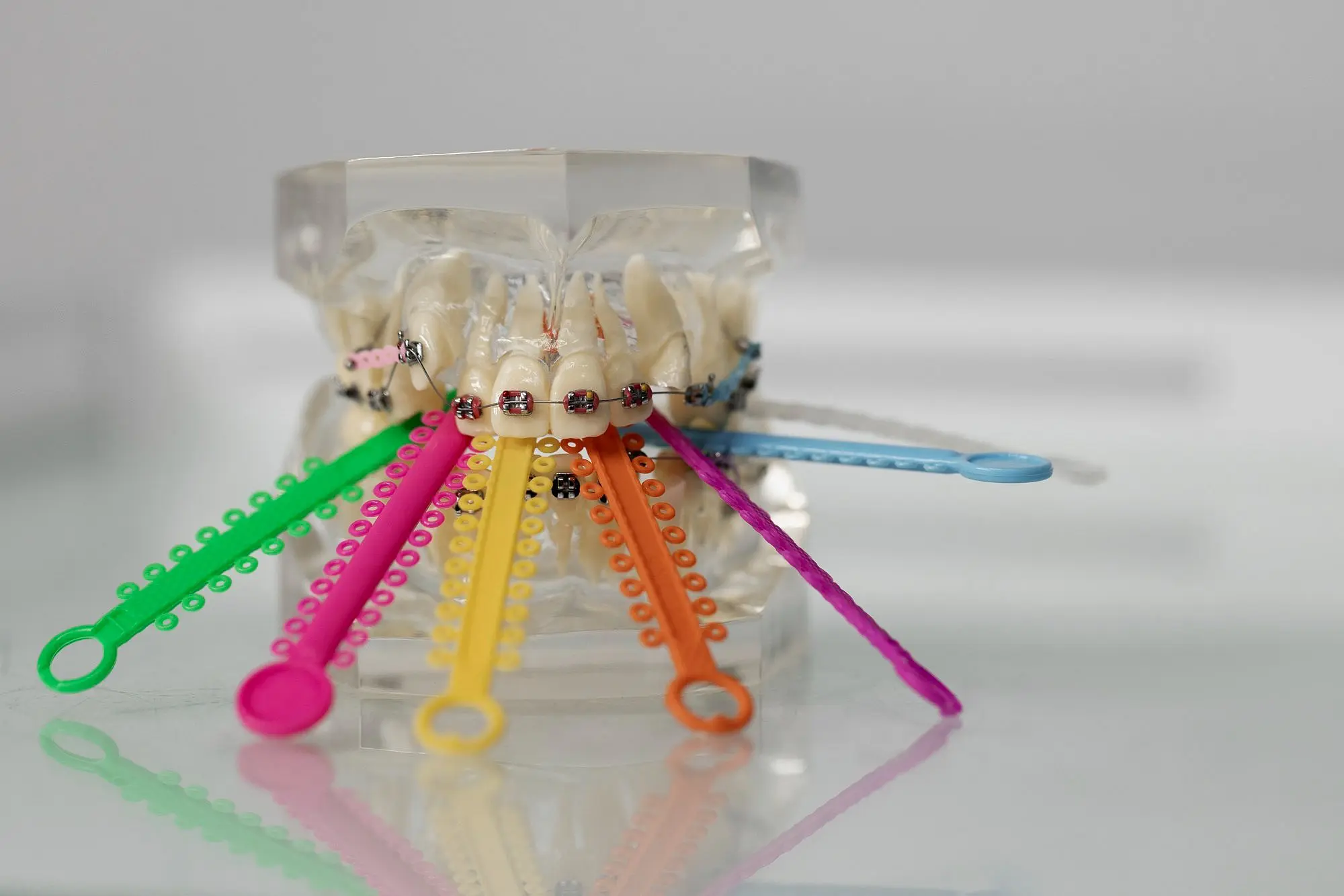 A dental model with metal braces at Natalie Yang Orthodontics in Vacaville, CA shows colorful elastic chains on brackets.