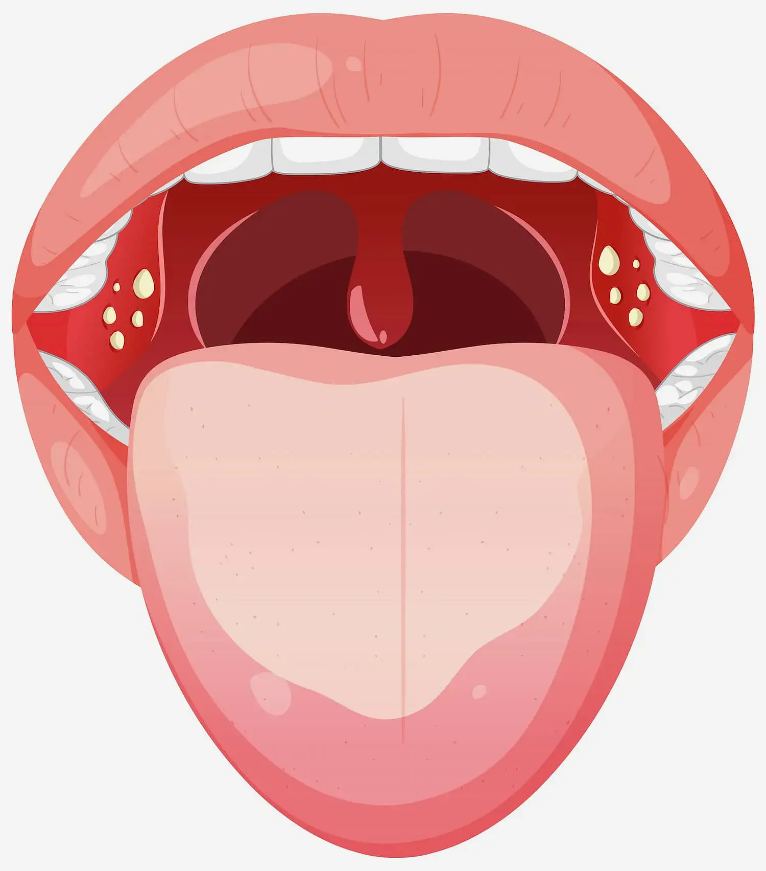 An open mouth with tongue thrust and white spots on tonsils, seen at Natalie Yang Orthodontics in Vacaville, CA. An open mouth with tongue thrust and white spots on tonsils, seen at Natalie Yang Orthodontics in Vacaville, CA.