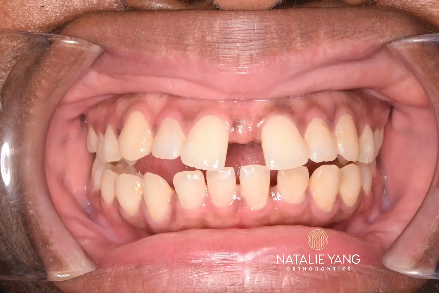A close-up of upper and lower teeth with a front gap, a tongue thrust sign, features Natalie Yang Orthodontics Orthodontics in Vacaville, CA. A close-up of upper and lower teeth with a front gap, a tongue thrust sign, features Natalie Yang Orthodontics Orthodontics in Vacaville, CA.