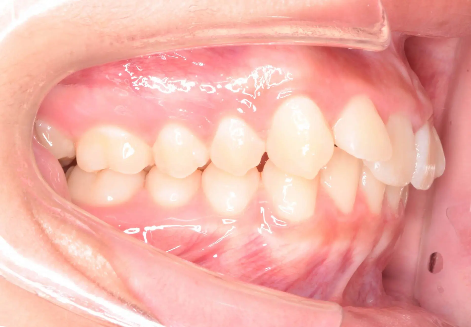 Teeth and gums with retractor show an overbite before Invisalign at Natalie Yang Orthodontics Orthodontics in Vacaville, CA.