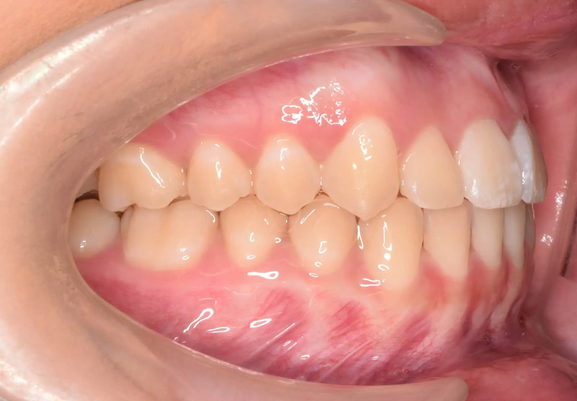 After Invisalign at Natalie Yang Orthodontics Orthodontics in Vacaville, CA: close-up of person's right side teeth and gums.