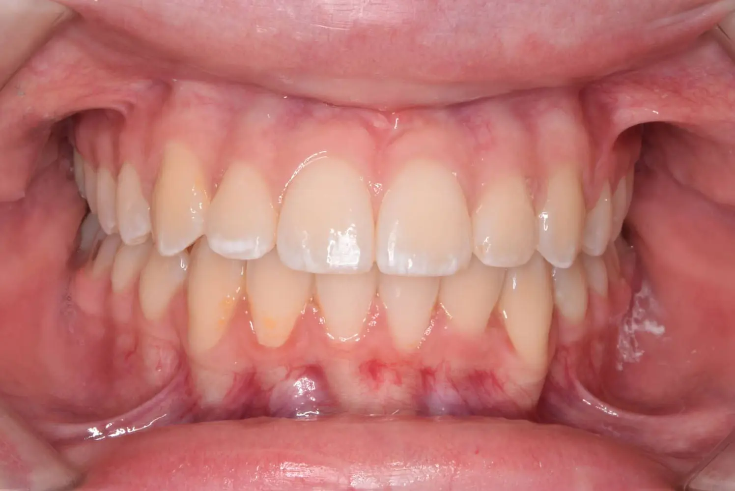 A mouth open to show aligned teeth and gums after braces at Natalie Yang Orthodontics Orthodontics in Vacaville, CA.