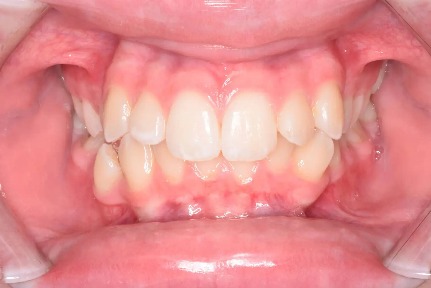 Dental crowding and misalignment of upper and lower teeth before braces at Natalie Yang Orthodontics Orthodontics in Vacaville, CA.