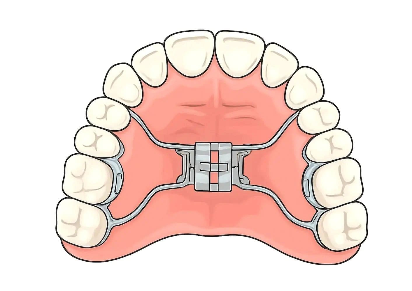 An upper jaw with a palatal expander device, as used at Natalie Yang Orthodontics Orthodontics in Vacaville, CA.